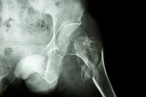 Hip Fractures, an Age-Old, Old Age Misery